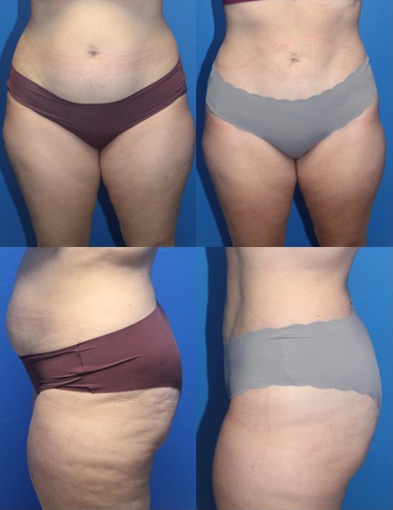 Before And After Patient