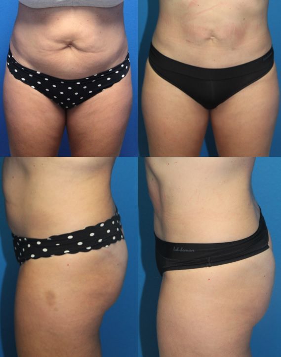 Before And After Patient