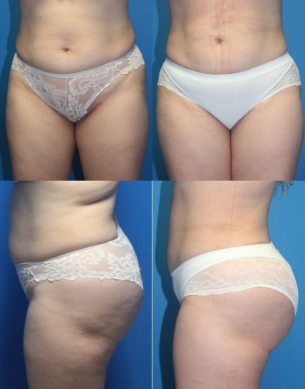 Before And After Patient