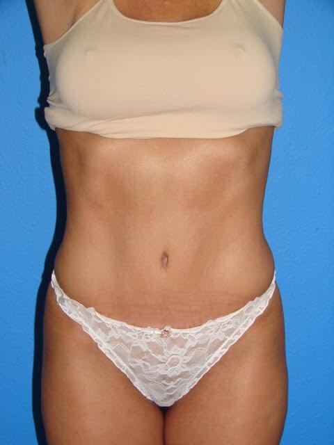 mommy-makeover-03 after